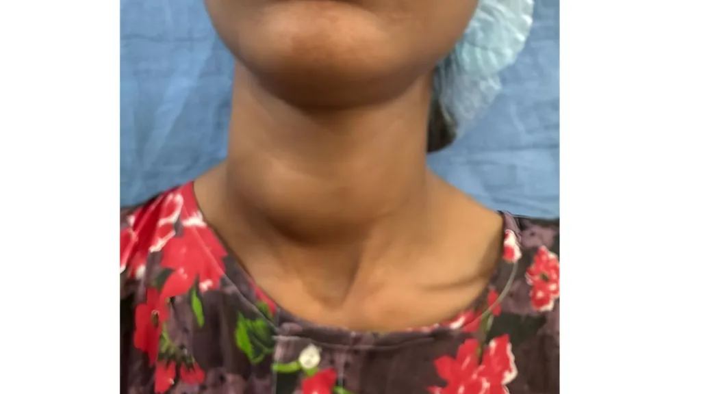 Rajasthan’s First Retroauricular Endoscopic Thyroid Surgery Performed Successfully at SMS Hospital 2 Thyroid swelling visible before surgery